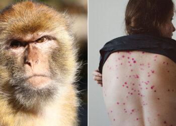 Salud: Confirmaron el quinto caso de viruela del mono en Argentina 15 2024