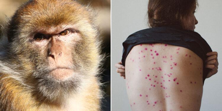 Salud: Confirmaron el quinto caso de viruela del mono en Argentina 1 2024