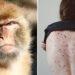 Salud: Confirmaron el quinto caso de viruela del mono en Argentina 3 2024