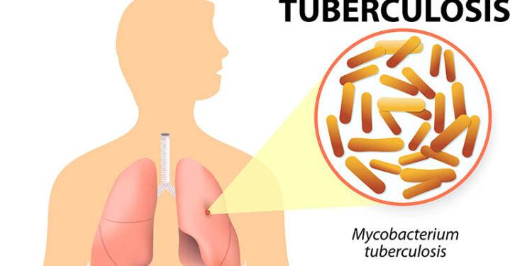 En 2022, Misiones diagnosticó 224 casos de tuberculosis 1 2023